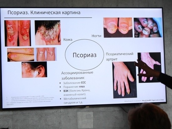 Свердловские врачи призывают больных псориазом пройти бесплатное лечение